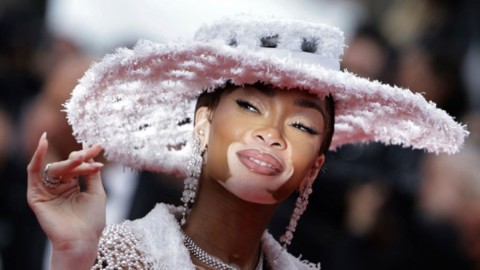 Vitiligo - šarena koža vodi nevidljive bitke thumb2.jpg